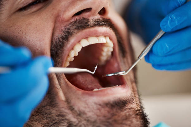 Best Knocked-Out Tooth (Avulsed Tooth) Treatment in Winnemucca, NV